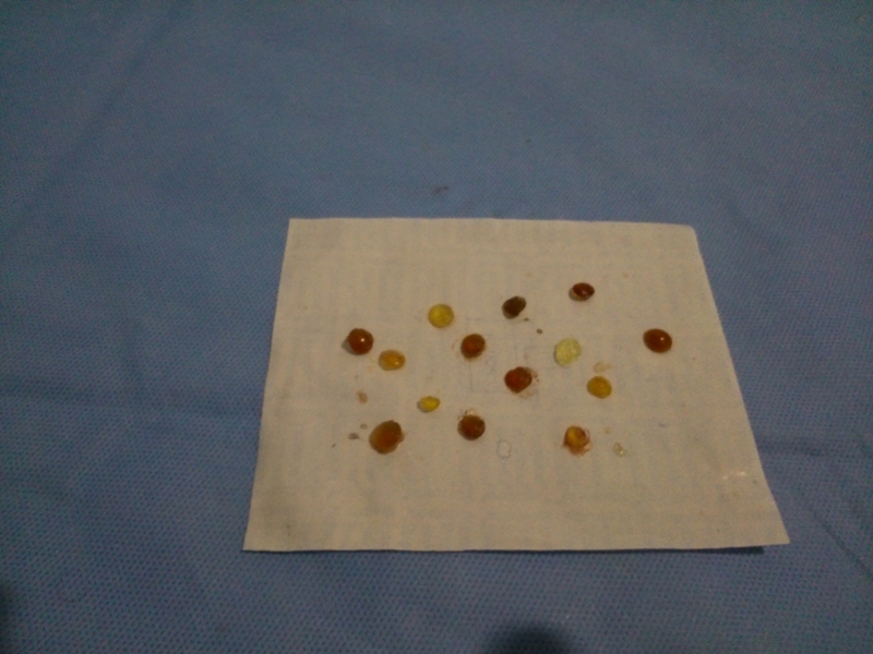 verwijderde troebele lenzen op tafel